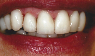 Porcelain Crowns & Veneers