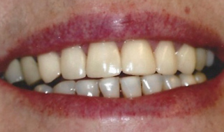 Porcelain Crowns & Veneers