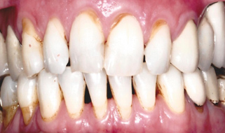 Porcelain Crowns & Veneers